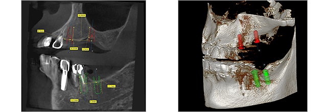 最新式の歯科用CT（Prevista Uni-3D）レントゲン